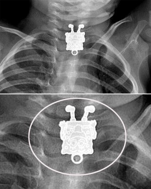 食道で「スポンジボブ」がニッコリ！医師もビックリなレントゲン写真