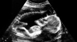CTスキャンの胎児写真が結構怖い