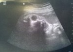 CTスキャンの胎児写真が結構怖い