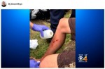 サメに襲われた傷跡　※海外メディア「Huffington Post」のスクリーンショット