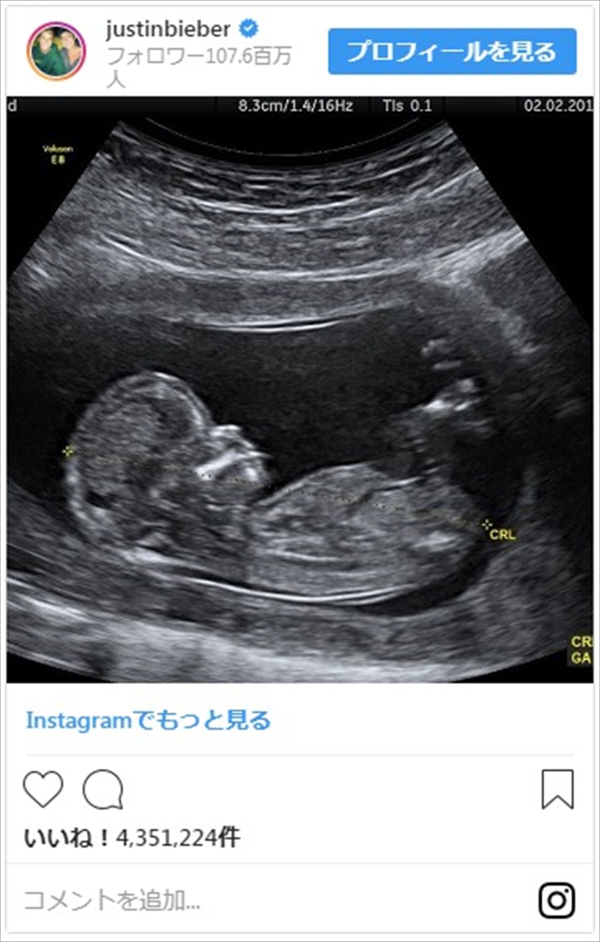 ジャスティン・ビーバー、エイプリルフールに胎児のエコー写真でファン混乱