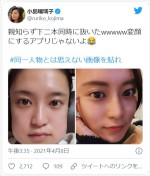 小島瑠璃子、親知らず2本抜歯後の顔の変化に驚き　※「小島瑠璃子」ツイッター