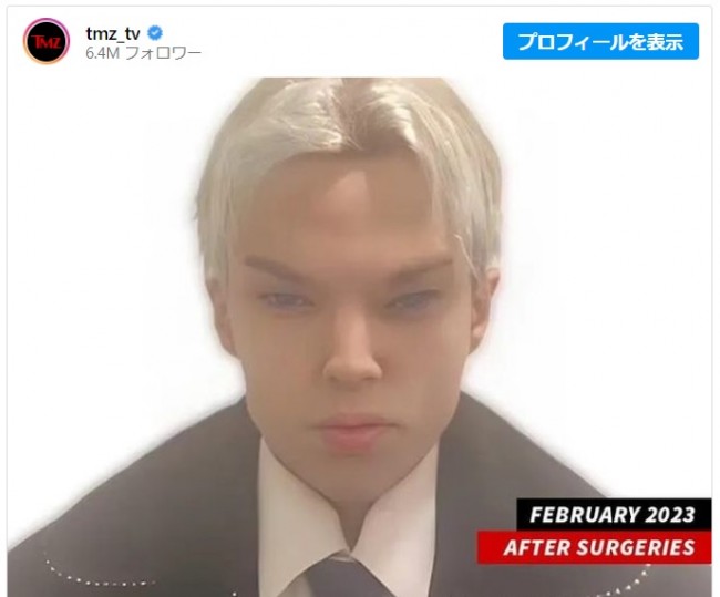 整形手術後のセイント・フォン・コルッチさん　※「TMZ」インスタグラム