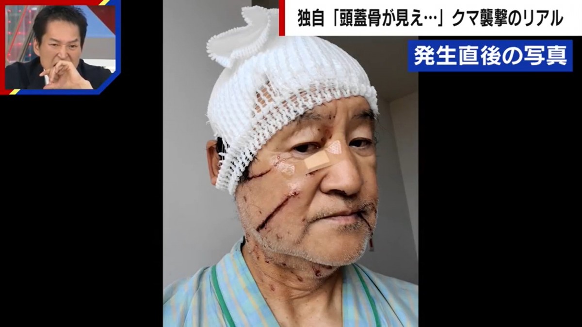 推定100kgのクマに襲われた男性　失明の危機　後遺症も