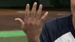 昨年のWBCで右手の小指を骨折した源田壮亮選手の右手
