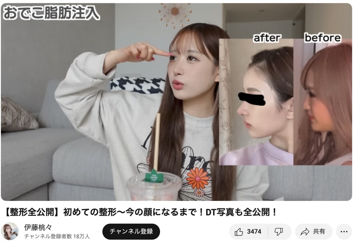整形公表美女たちのビフォーアフター　総額いくら？　どこを変えたの？　赤裸々告白
