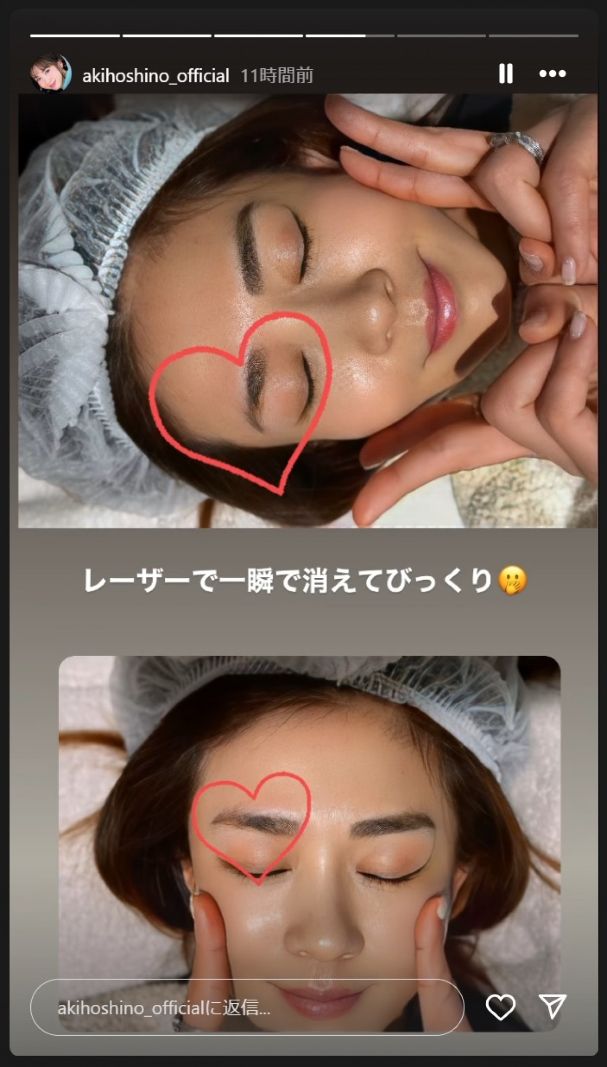 ほしのあき、アートメイクの除去を写真とともに報告　※「ほしのあき」インスタグラム