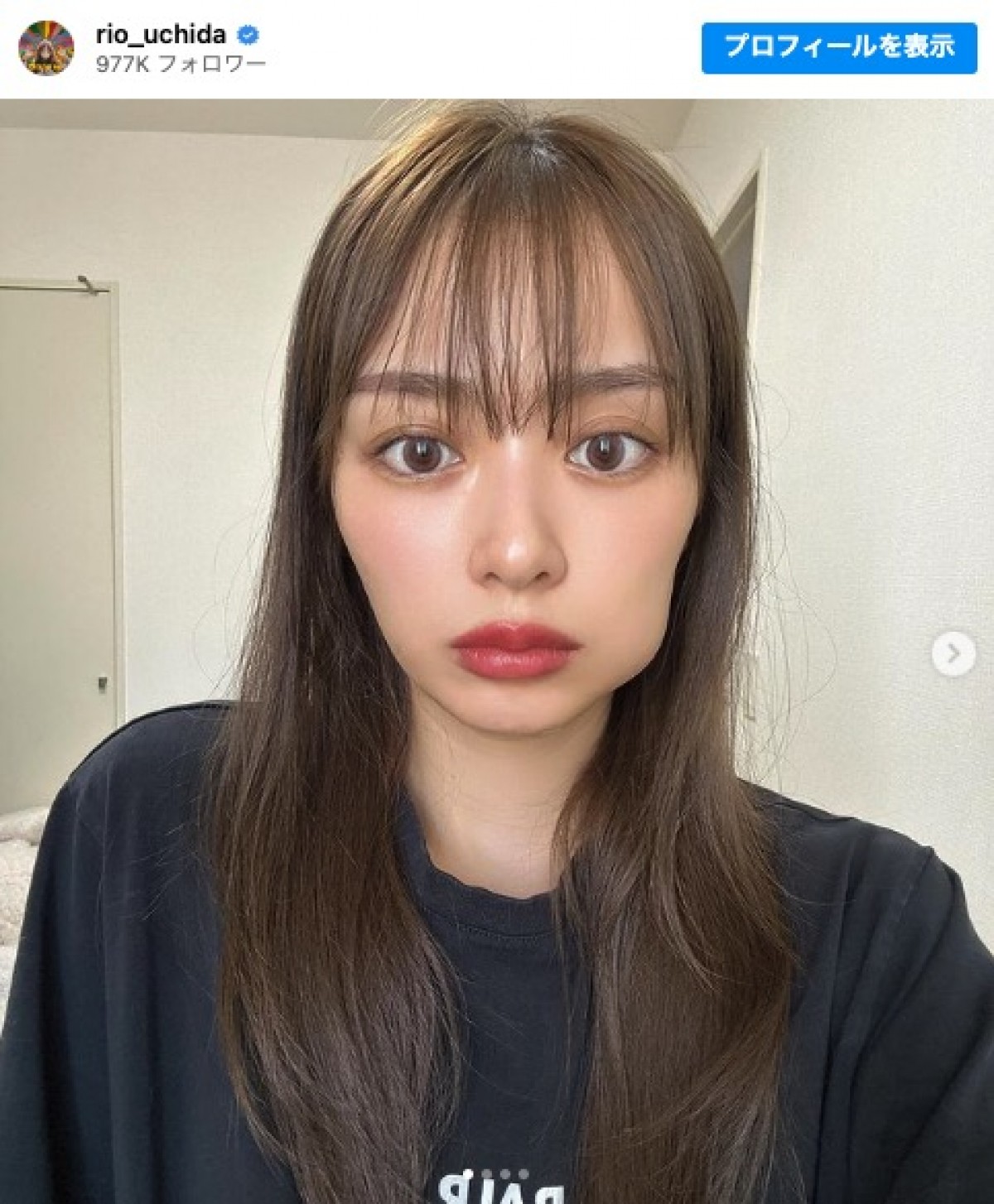 親知らずを抜いた内田理央 ※「内田理央」インスタグラム」