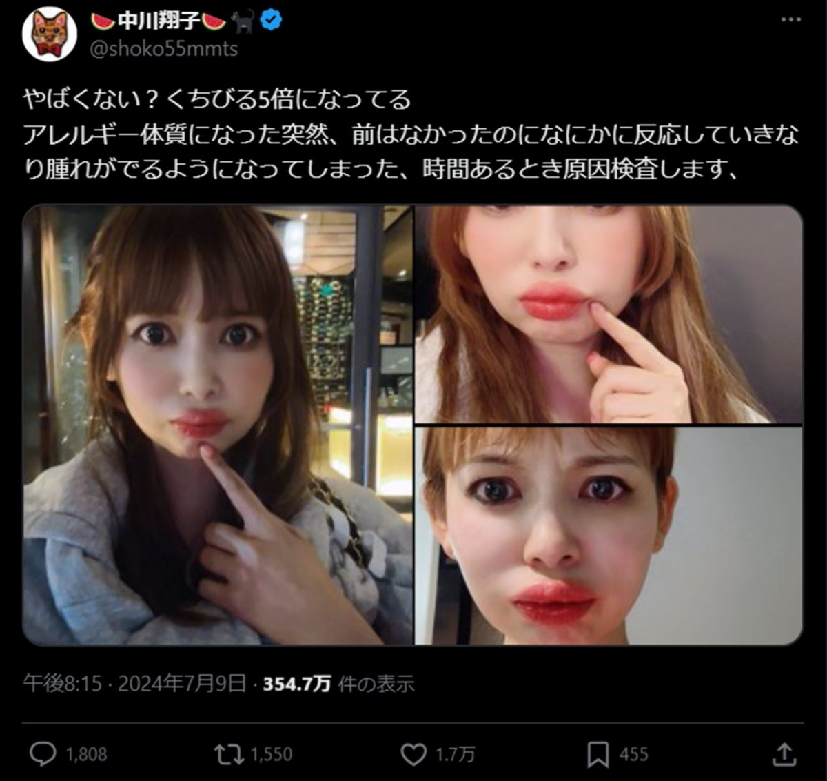 中川翔子、唇腫れた姿披露し話題に ※「中川翔子」エックス