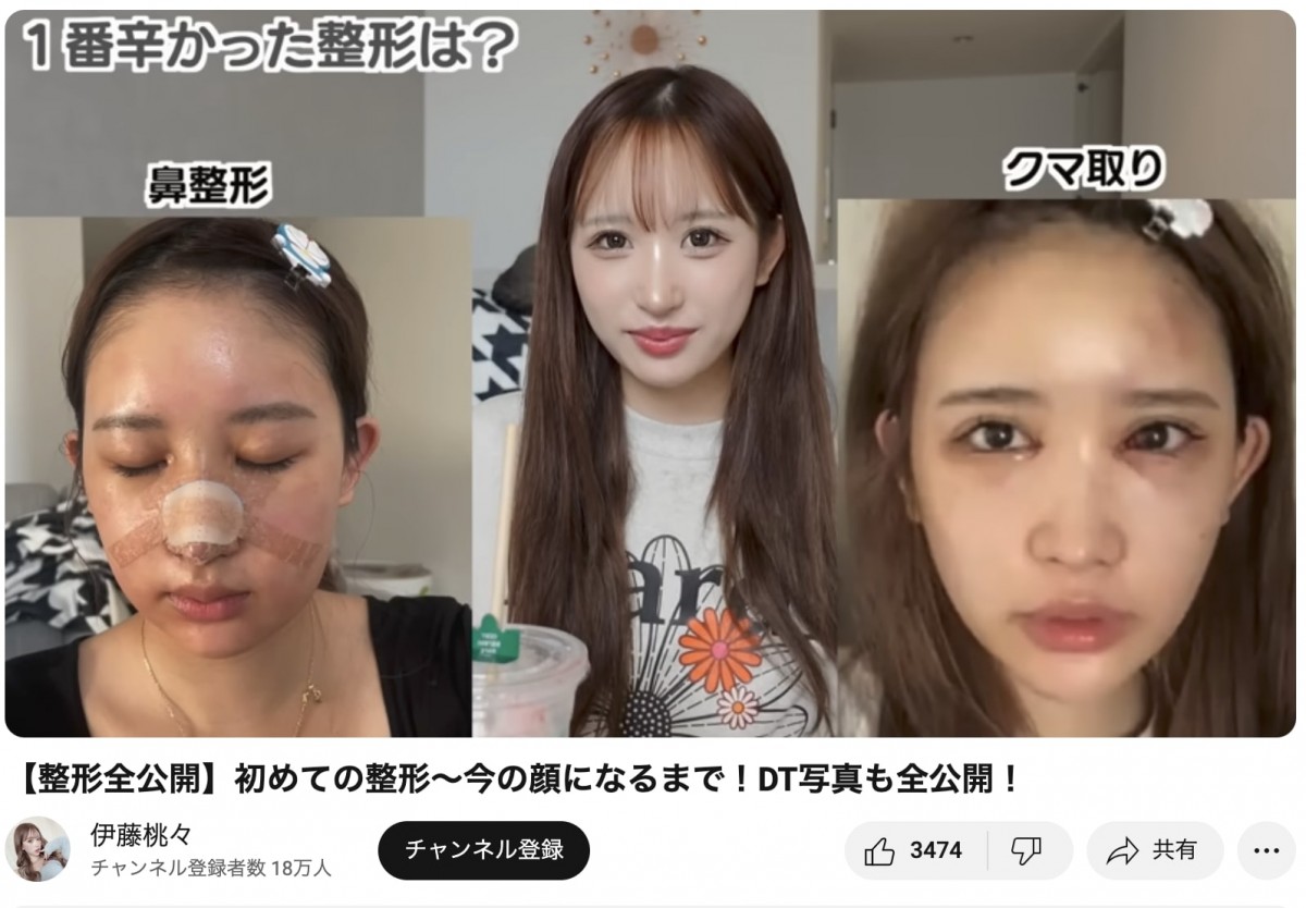 整形公表美女たちのビフォーアフター　総額いくら？　どこを変えたの？　赤裸々告白
