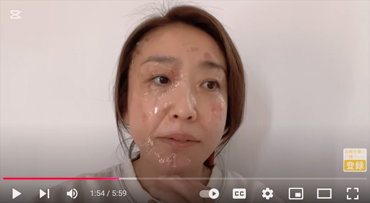 元国民的美少女タレント「顔面を大火傷しました」　ファン心配「痛々しい」「キレイなお顔が、、」