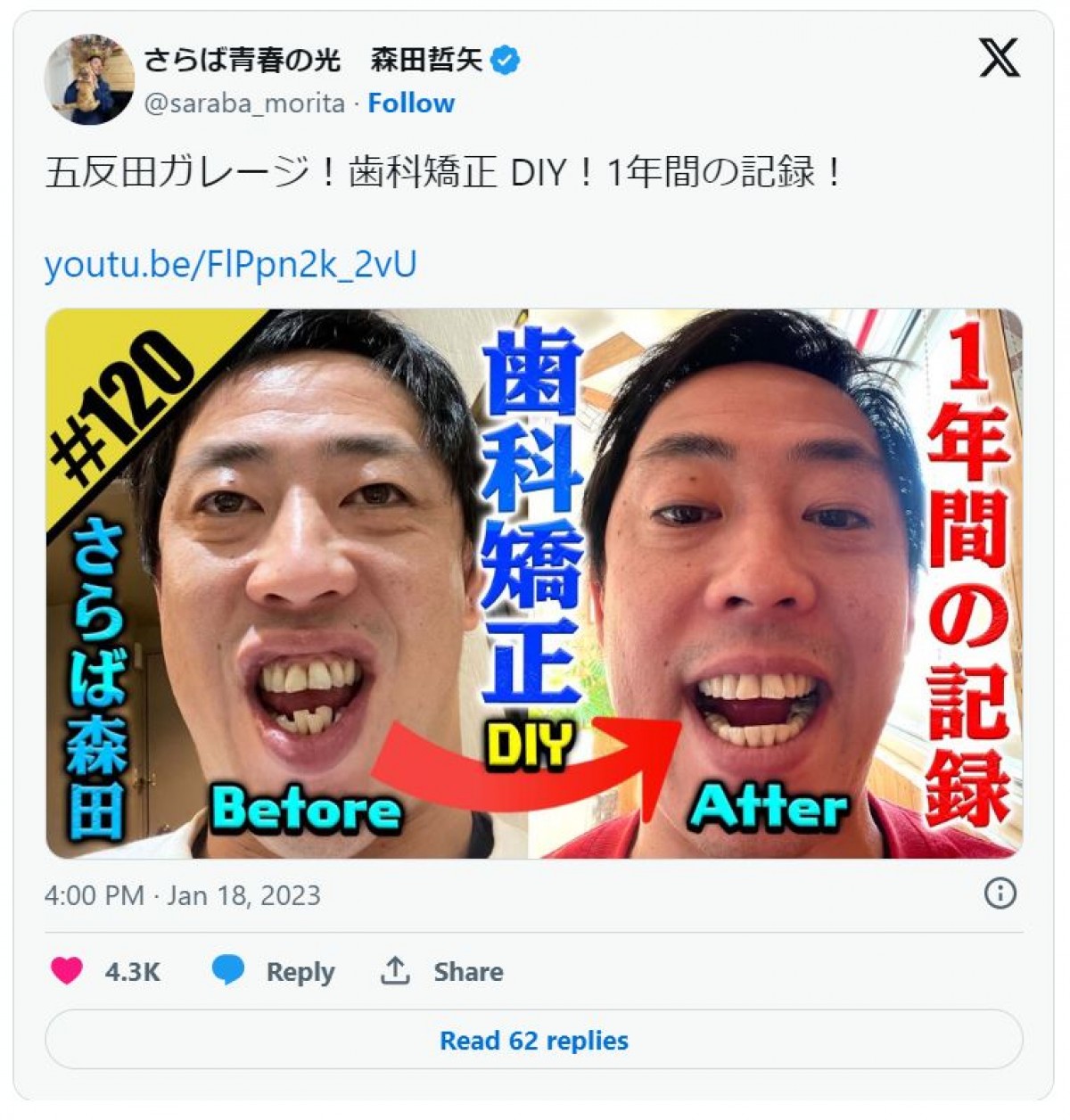 歯列矯正した芸能人ビフォーアフター！　「ガタガタだった」元トップアイドルに“口元排水溝”芸人も