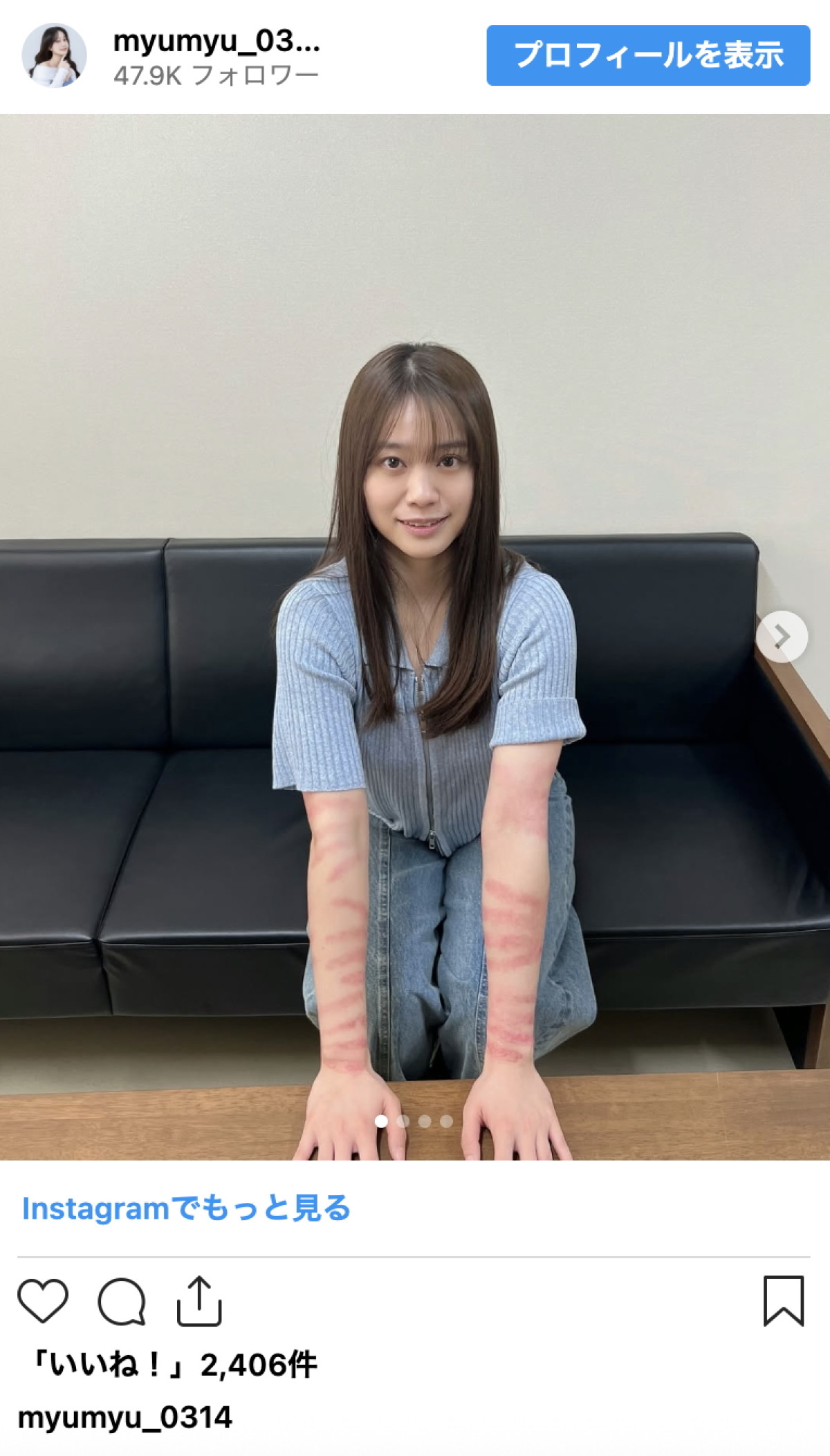 森山未唯、両腕に“無数の手形”がびっしり「痛々しさと怖さがありますね」