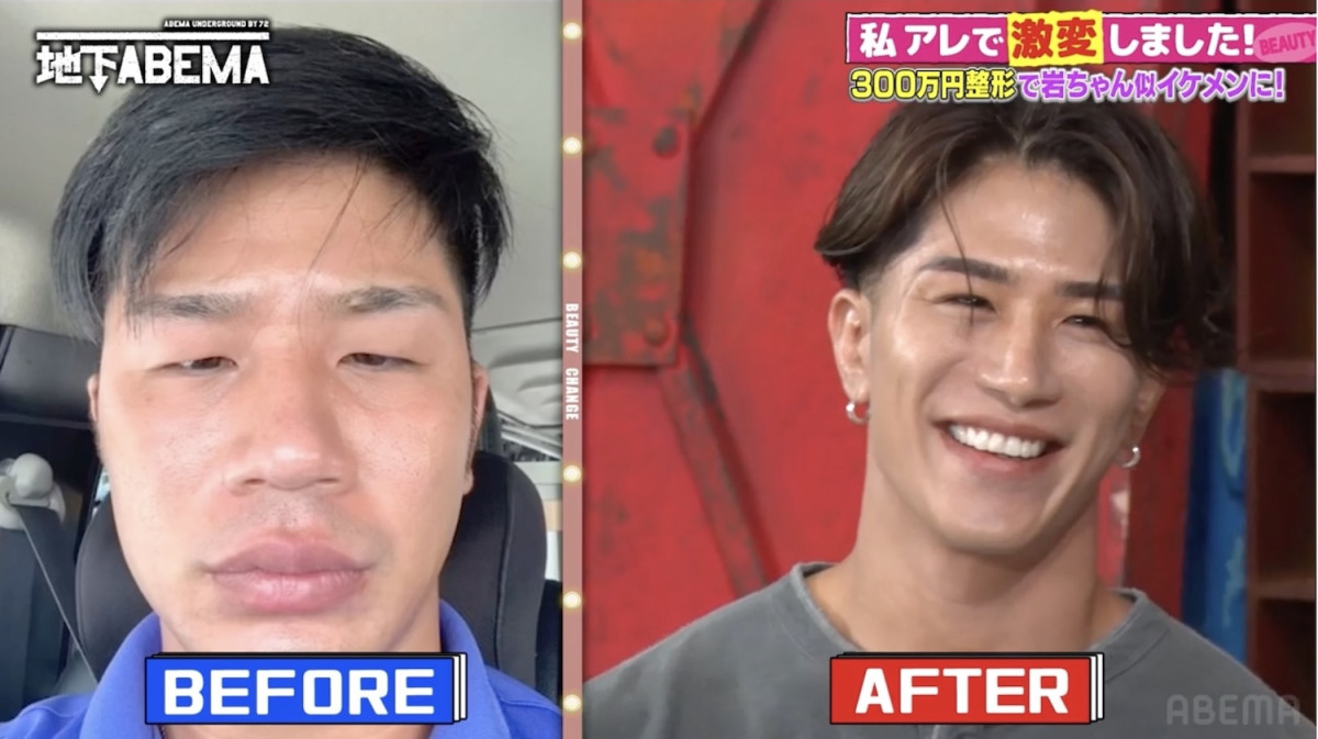 整形総額300万円で岩田剛典似に“激変”した男性、マチアプで爆笑体験