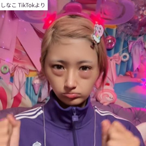 しなこ、いきなり目が腫れて急遽病院へ　「ちょっと落ち込みしなこです」