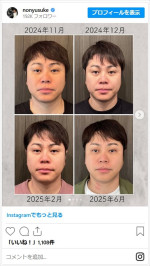 井上裕介、頭蓋骨マッサージの効果を披露　※「井上裕介（NON STYLE）」インスタグラム